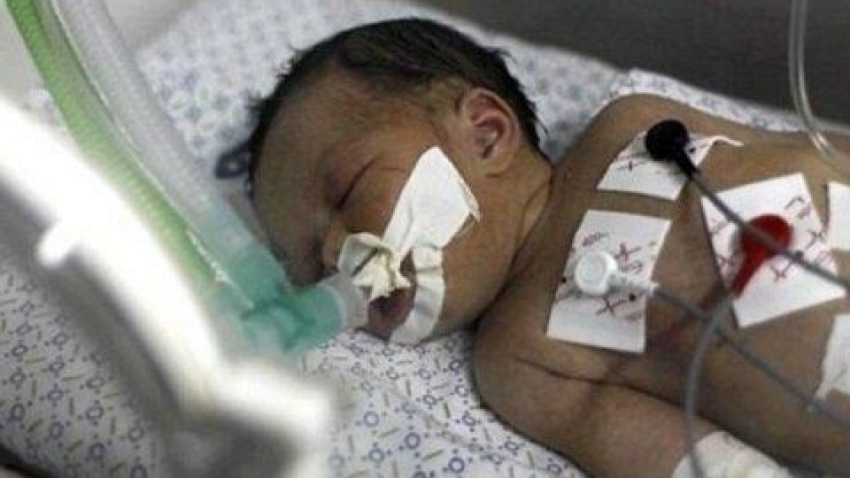 تراژدی نوزادان ناقصالخلقه در غزه؛ کودکی که بدون مغز متولد شد