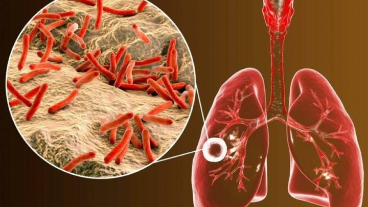 ابتلای ۶۵۰۰ نفر به بیماری سل در ایران/ ۲۴درصد غیرایرانی‌اند