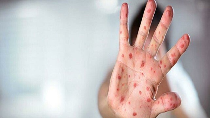 تایید رسمی حذف سرخک و سرخجه در ایران تا سال ۲۰۲۳