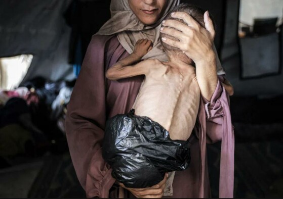 وزن محمد زکریا ایوب المعتوق، کودک ۱۸ ماهه، که در چادری در شهر غزه زندگی می‌کند، جایی که مایحتاج اولیه وجود ندارد، از ۹ کیلوگرم به ۶ کیلوگرم کاهش یافته است. سوء تغذیه در این منطقه گسترده است.