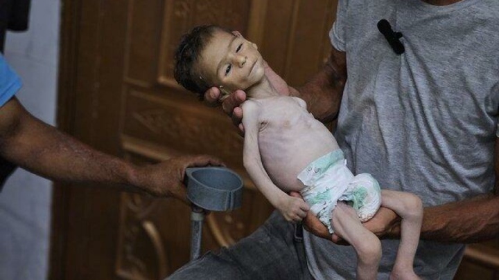 یک چهارم کودکان و زنان باردار در غزه از سوء تغذیه رنج می‌برند