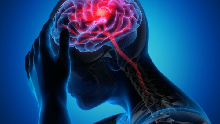 ایرانی‌ها ۱۰ سال زیر سن متوسط جهانی سکته می‌کنند