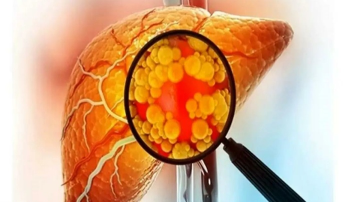 مبتلایان به کبد چرب دنبه نخورند!