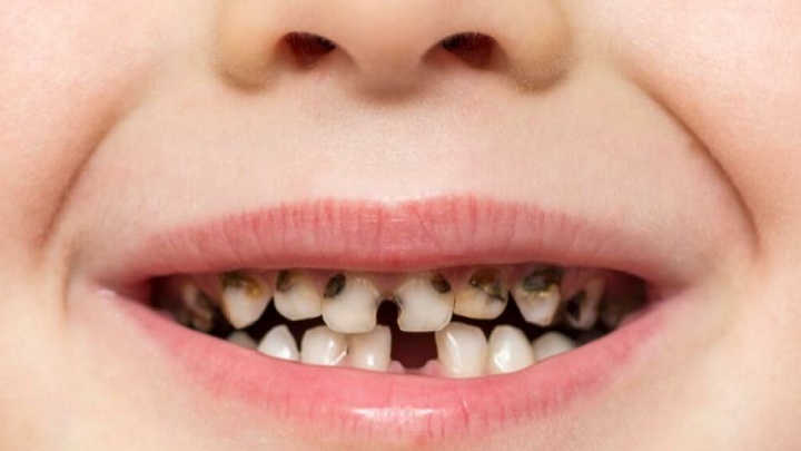 از هر ۱۰ نوجوان ۶ نفر پوسیدگی دندانی دارند