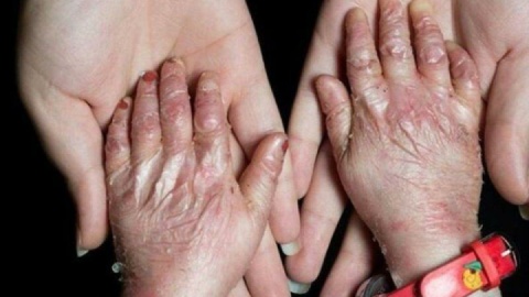 ۹۵ درصد بیماران «ای بی» حاصل ازدواج فامیلی