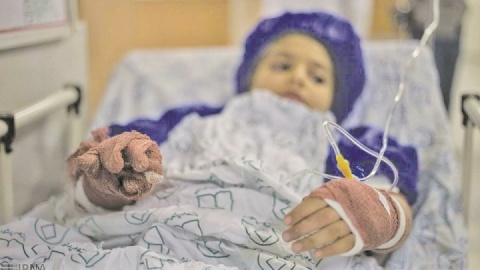 سالانه ۳۰۰ هزار نفر در کشور دچار سوختگی می‎شوند