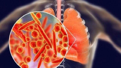 بیماری انسدادی مزمن ریه چهارمین علت مرگ‌ومیر جهان است