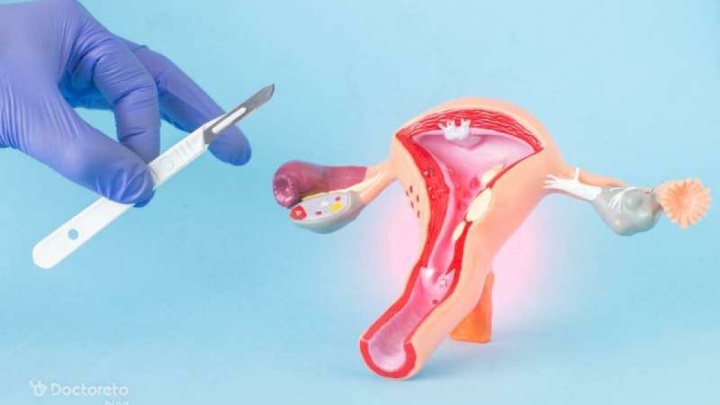 ایران در درمان اندومتریوز بالاتر از اروپا و آمریکا