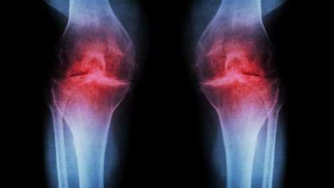 امید تازه برای درمان آرتروز