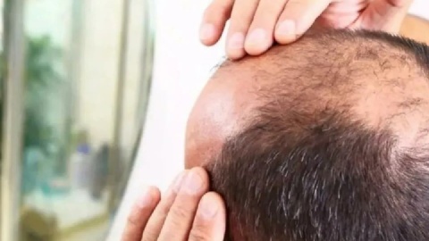 درمان طاسی با یک قند